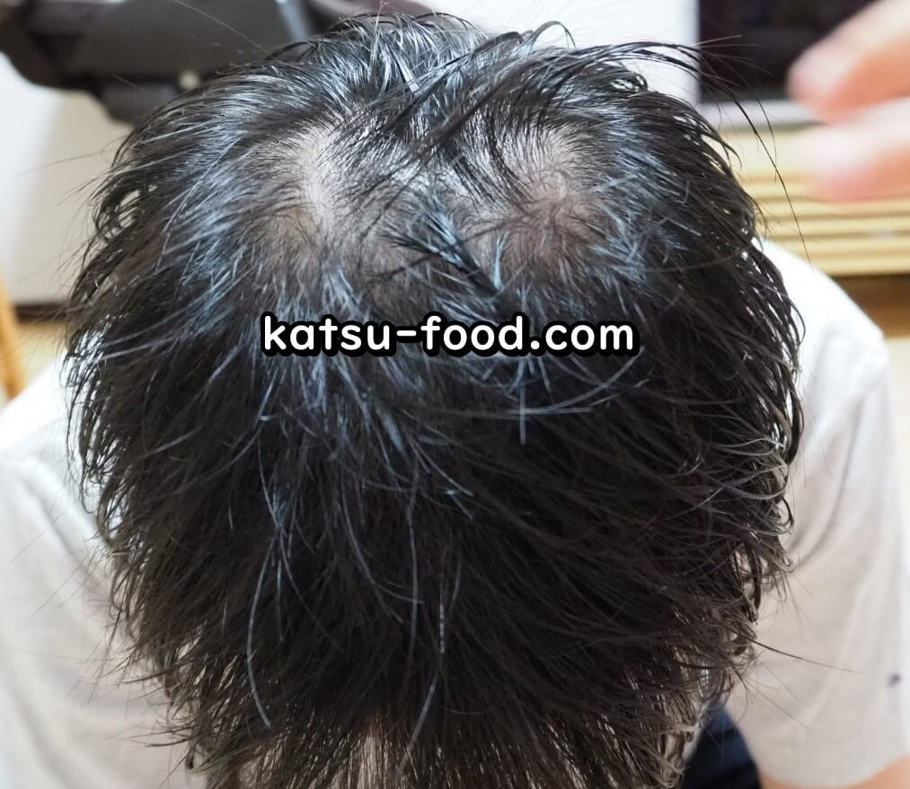 ハゲ画像 頭皮マッサージ器で髪が生えてくるのか検証 1年後の毛量は かっつ飯 飯テロ検定準2級保持者のバズり飯 インスタ界最強の男飯