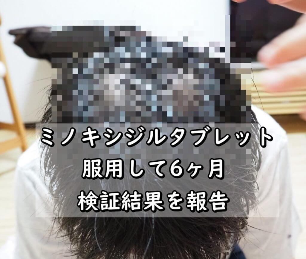 【ハゲ画像】ミノキシジル(ミノタブ)の効果検証!!服用して6ヶ月でふさふさに!?
