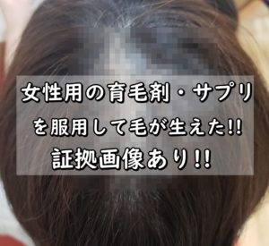 【画像】女性用の育毛剤・サプリで毛が生えた!!つむじハゲに効果あり!!